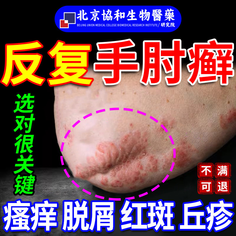 手肘癣胳膊肘癣止痒神经性皮炎顽固性皮癣手臂瘙痒起皮脱皮红斑ku