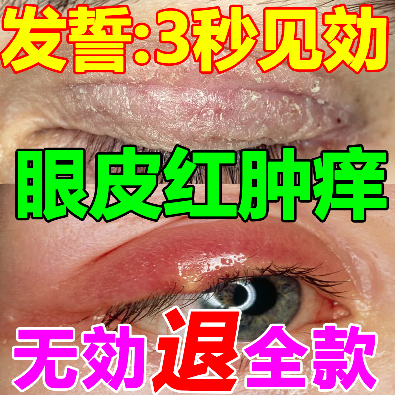 眼皮癣红肿痒过敏干燥消肿眼睛周围过敏眼角止痒脸起皮有碎屑药膏 洗护清洁剂/卫生巾/纸/香薰 乳液/面霜 原图主图