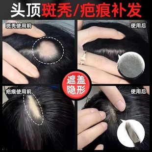疤痕补发贴头部伤疤斑秃烧伤头顶疤痕补发片定制生物头皮假发贴