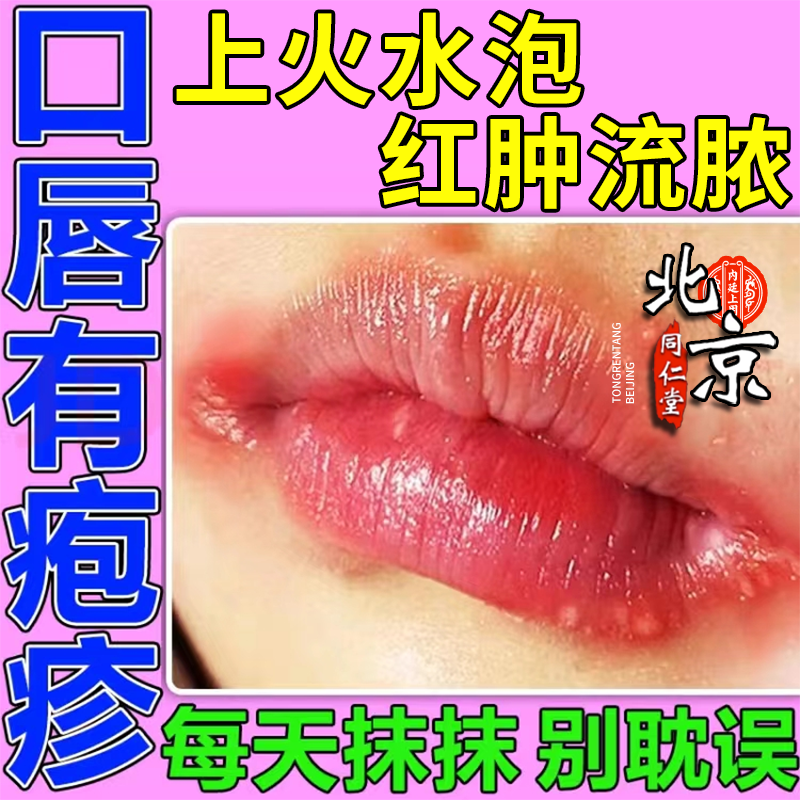 口唇疱疹嘴巴上火起泡烂嘴角溃烂疱疹膏修护溃疡口角炎嘴角开裂pg