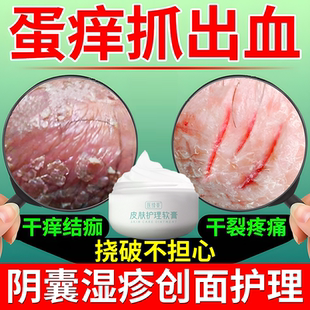 男性阴囊湿疹瘙痒软膏止痒去喷雾根潮湿私处睾丸癣蛋皮瘙痒脱皮CA
