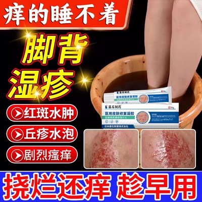 脚部湿疹脚背止痒去专用脚气膏干性皮疹根足癣真菌感染丘疹瘙痒CA