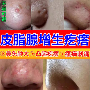鼻头增生鼻子上长肉疙瘩皮脂腺粟丘疹脸上起小疙瘩掉皮药房同款CA