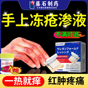 手上长冻疮冻疮贴可搭配冻疮膏止痒冻伤膏官方旗舰店QK