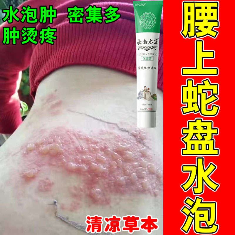 腰带状水小泡后遗症神经红肿痛痒草本乳膏真菌皮肤刺痛膏