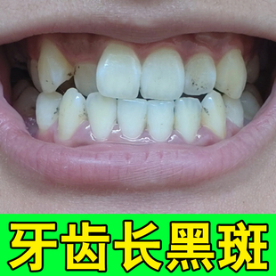 牙根发黑专用牙黑牙黄牙渍牙垢牙斑净牙菌斑氟斑牙