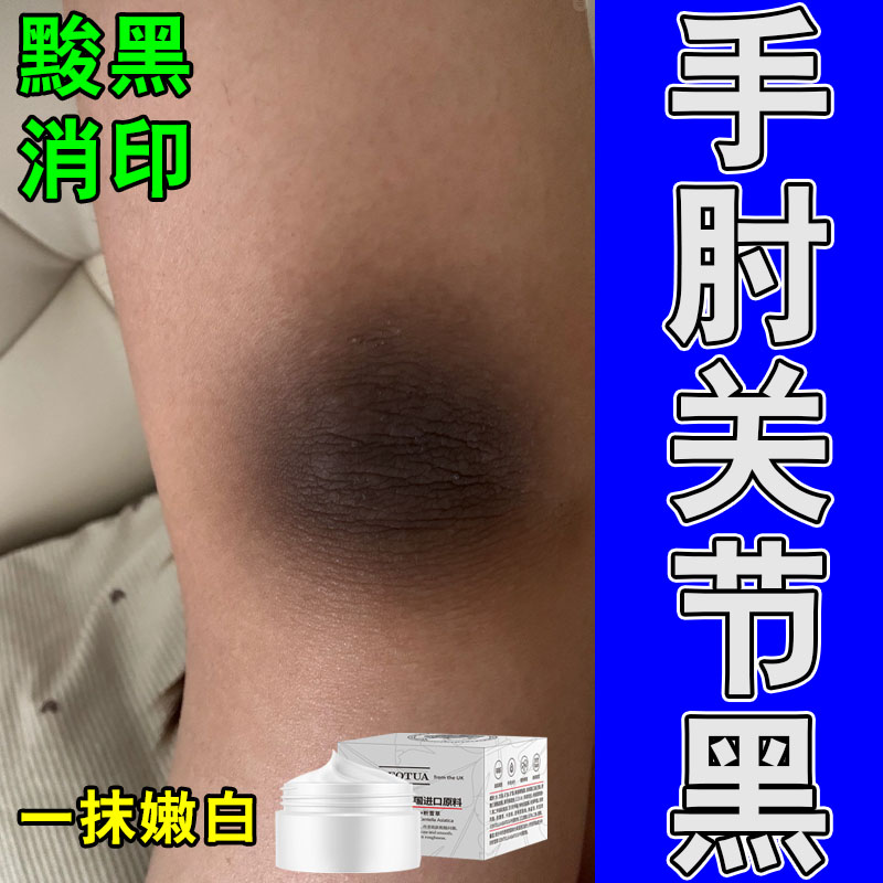 胳膊肘黑黑去黑皮手肘黑色素沉淀快速去除膝盖关节黑淡黑按摩膏
