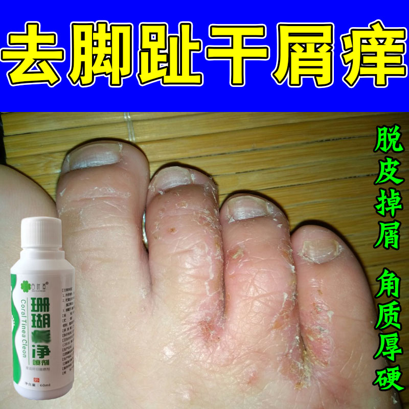 脚关节趾修护膏舒缓脚趾关节干燥起皮发痒淡化脚趾红斑小疙瘩软膏