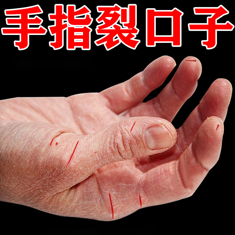 冶手裂的膏防皲裂脚后跟干裂起硬皮足跟开裂修复霜手指裂口软膏