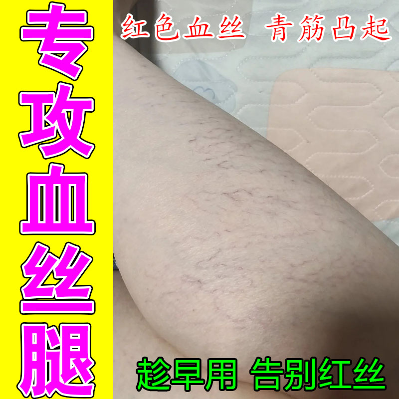 腿上红血丝血管扩张凸起青筋扩血丝修复屏障受损腿青筋凸起保湿膏