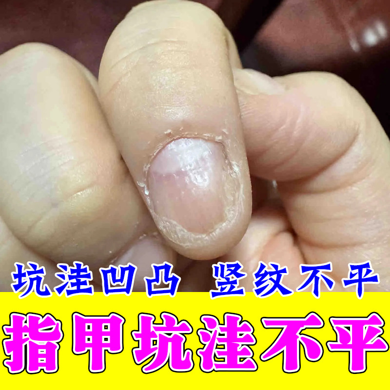 受损指甲凹陷变形坑坑洼洼手指甲凹凸不平有横纹甲空心甲修复液