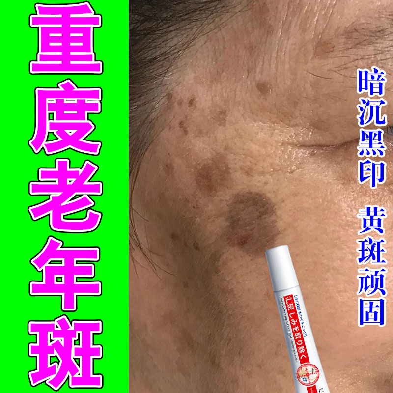 老年身上脸部黄斑雀斑暗沉脸部手部黑斑晒斑男女通用修护白嫩软膏