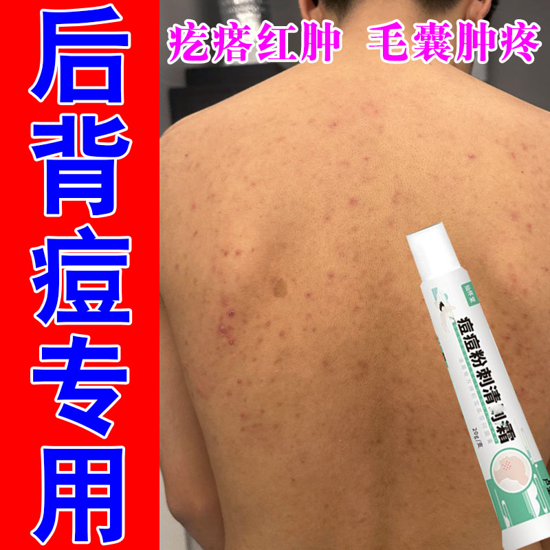 专冶后背疙瘩痘毛囊长痘脓包疙瘩毛囊发痒堵塞肿痒草本修护膏乳