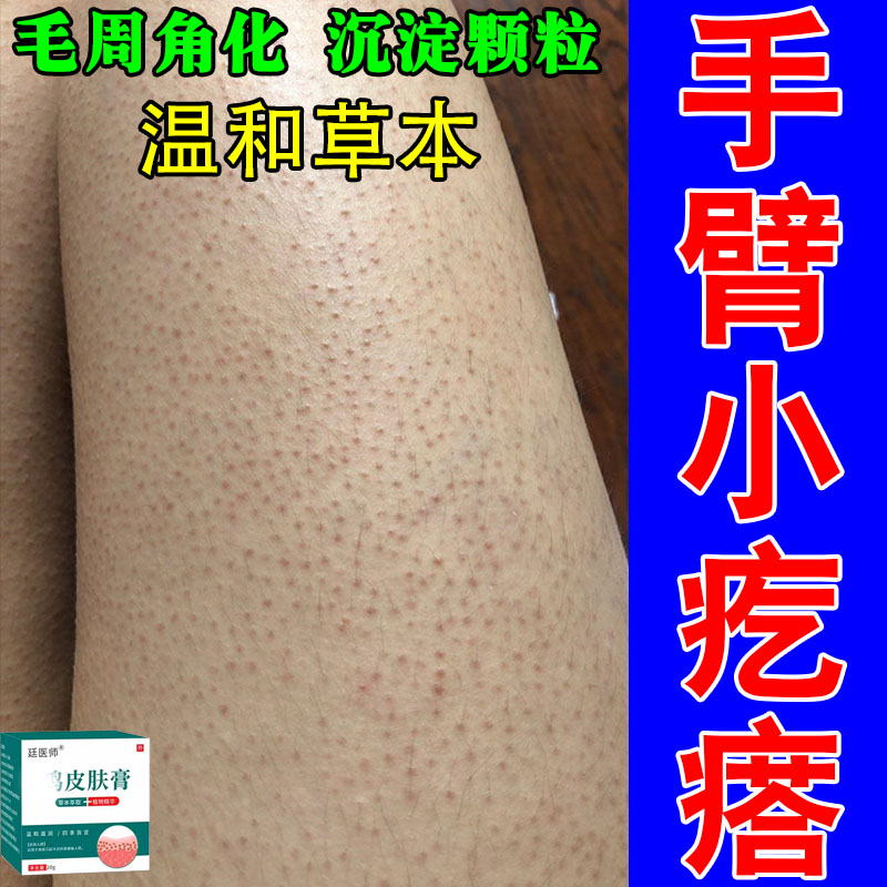 手臂鸡皮肤疙瘩毛囊毛周角化胳膊腿上红点角质毛孔堵塞舒缓霜