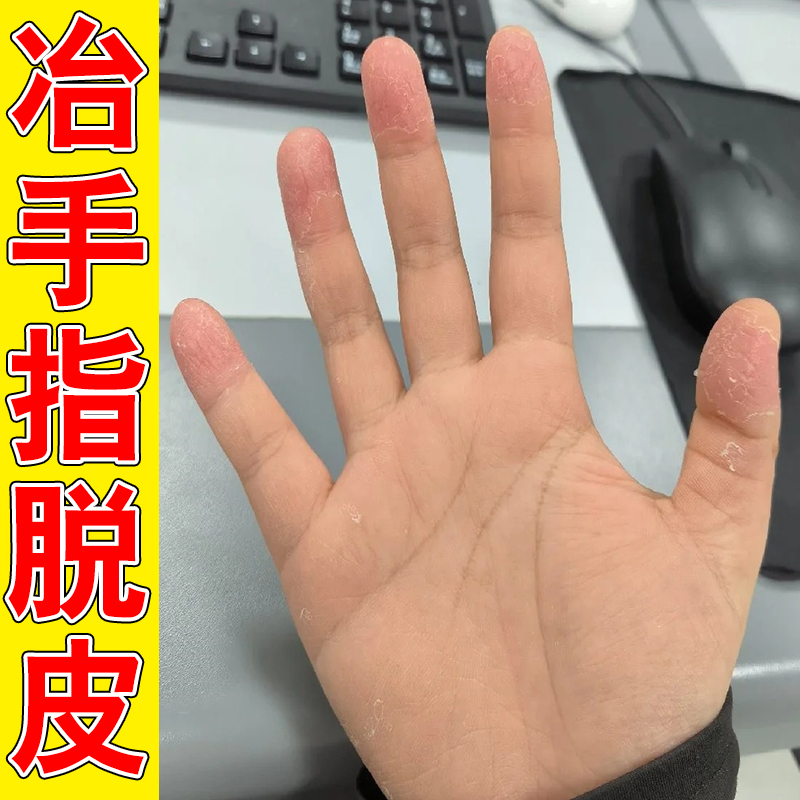 手指头裂口子脱皮手指缝开裂指尖裂口冬季手干裂滋润软膏