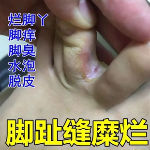 脚底脱皮起皮红肿指缝开裂发白膏