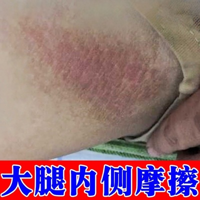走路磨大腿摩擦胖人大腿内侧出汗红肿刺痛男士根部潮湿红斑烧裆
