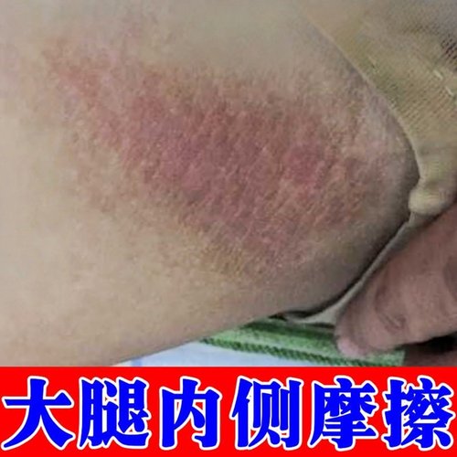 走路磨大腿摩擦胖人大腿内侧出汗红肿刺痛男士根部潮湿红斑烧裆