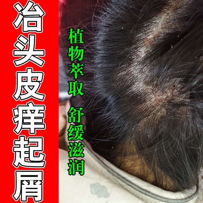 冶头上干燥发痒起干皮粗糙泛红肿痒草本萃取修护膏乳