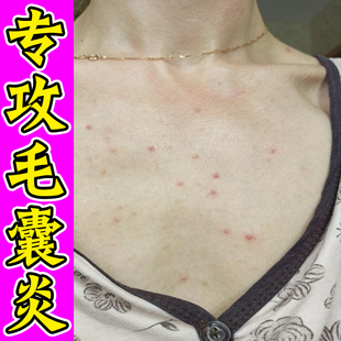 胸前豆豆胸口发红发痒长小红点疙瘩背上脓包前胸后背去痘专用软膏