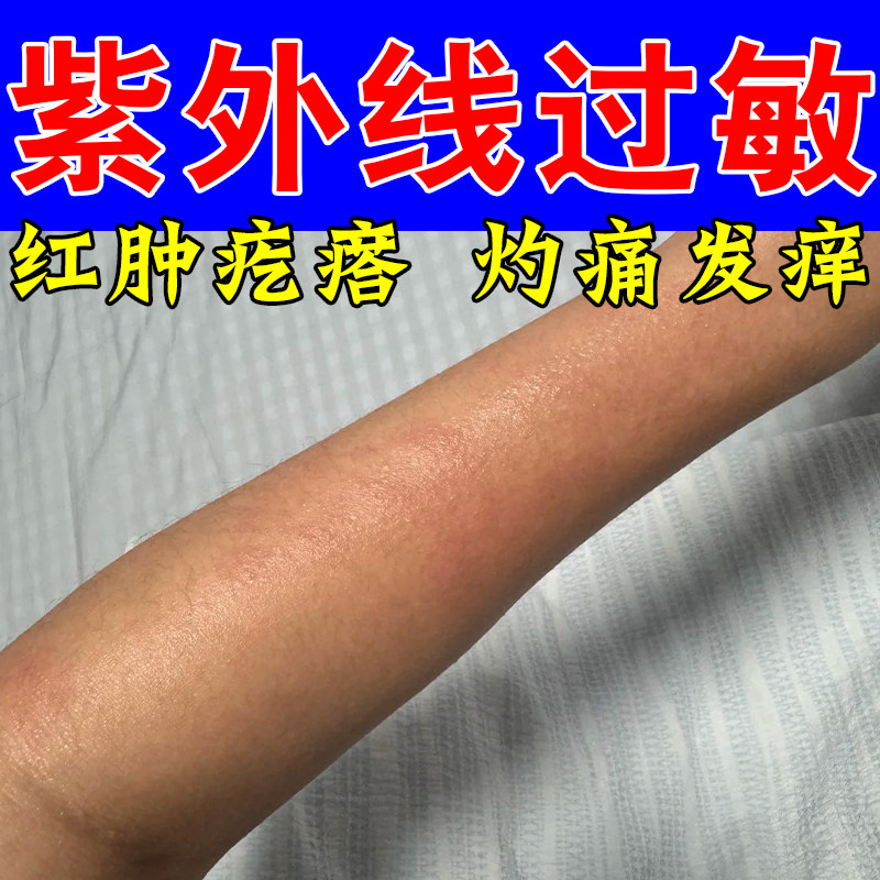 日光性敏感紫外线伤害起疙瘩肿痛泛红太阳晒伤皮肤发痒舒缓修护膏