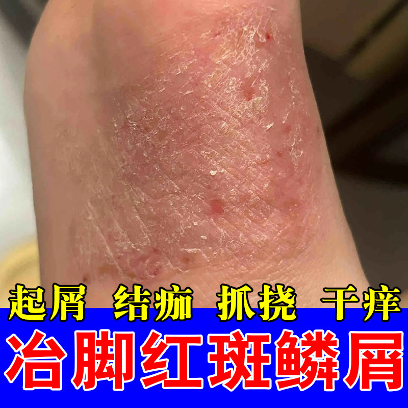 脚侧面疙瘩红痒神经性皮肤痒脚侧痒刺挠真菌脱皮粗糙干痒红修护膏