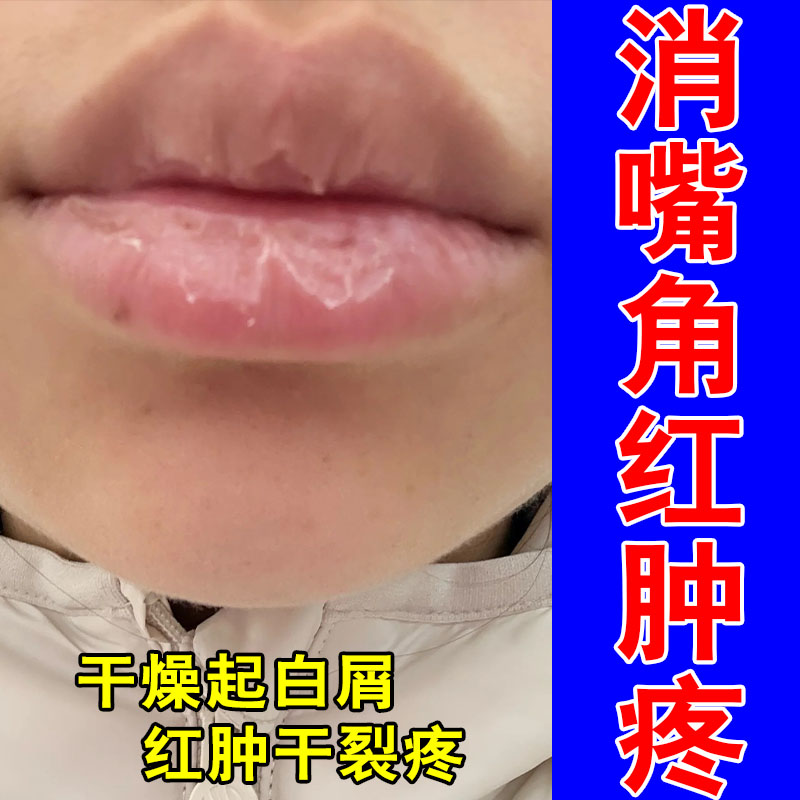 唇润嘴唇干裂脱皮滋润口角干燥起皮冶成人修护草本保湿膏