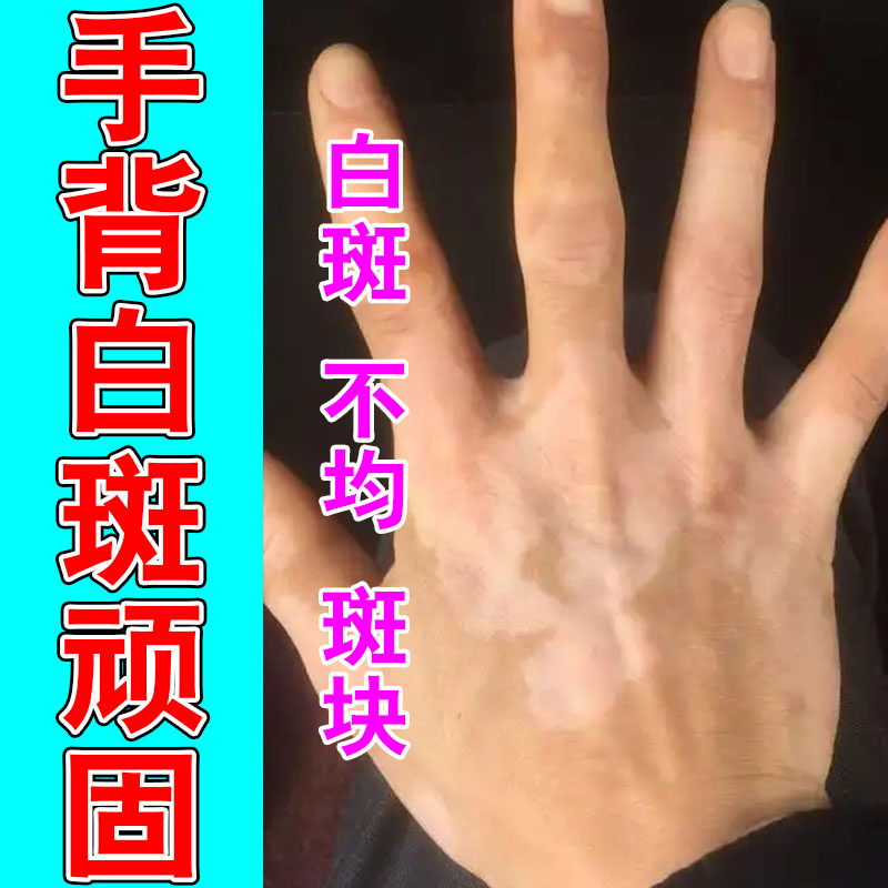 手指上明显白斑手臂上长小白点白斑黑色素少专用植物修护膏