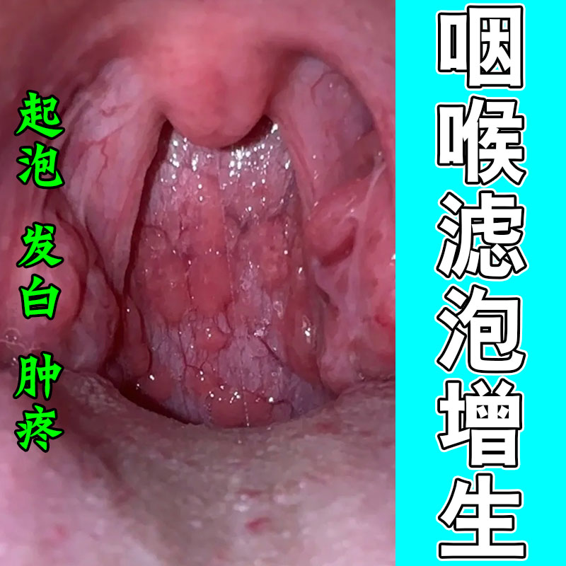 喉咙舌壁泛红发热异物感咽喉淋巴滤泡增生草本舒缓喷剂