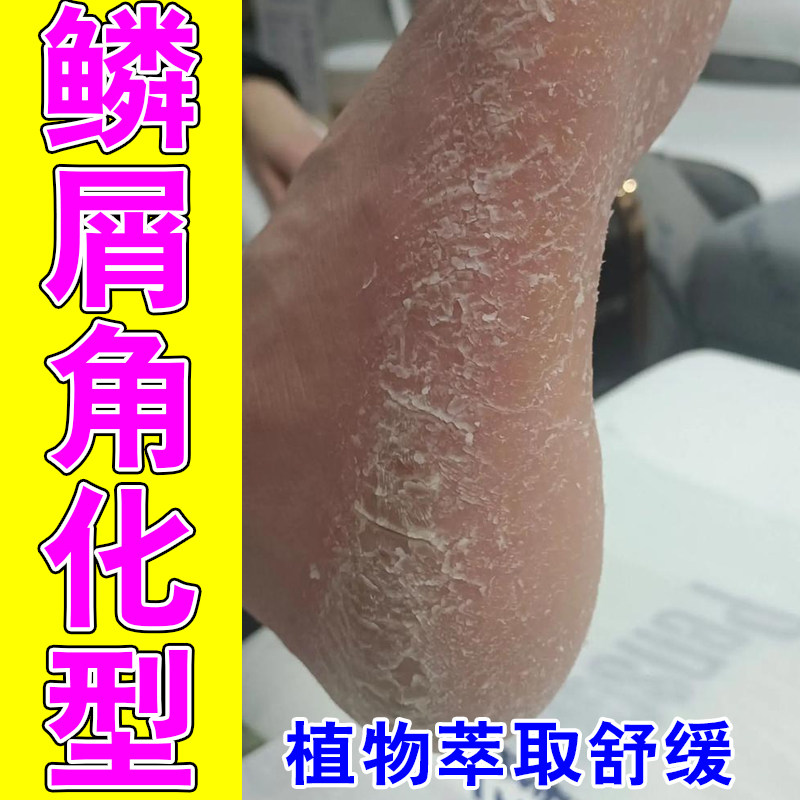 角化型气脚干裂脚后跟裂口起硬皮脚角质层增厚修复植物软膏