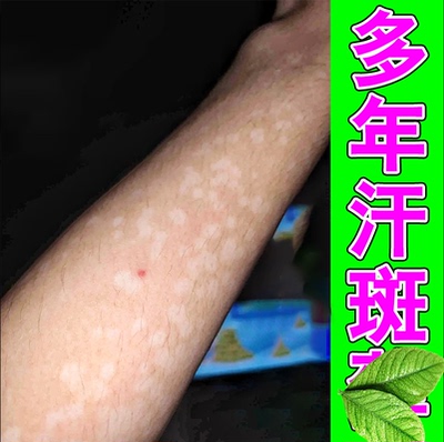 身上汗斑净汗斑花斑专用软膏全身长汉斑褐斑白斑点点促黑阻白膏