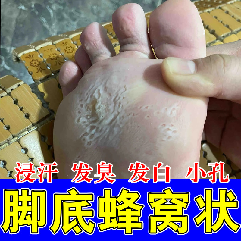 脚底板马蜂窝白孔汗多小孔窝状角质松解脚气臭脚出汗脚痒植物膏