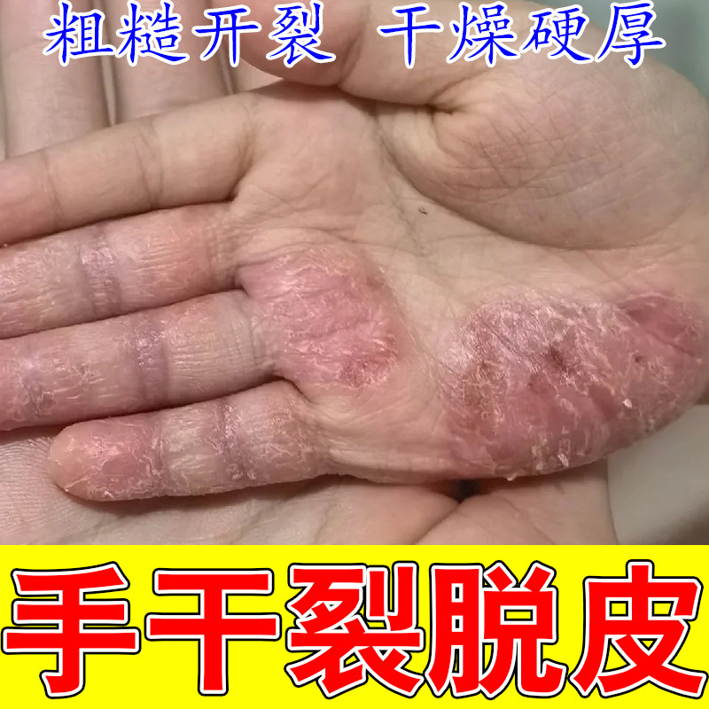 角化型手粗糙角质增厚变硬开裂手指干裂皮肤粗糙保湿干裂硬皮软膏
