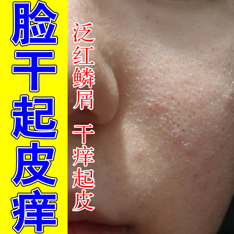 脸颊干燥刺痛泛红起皮嘴周掉屑下巴干裂脱皮舒缓保湿甘油修护精油
