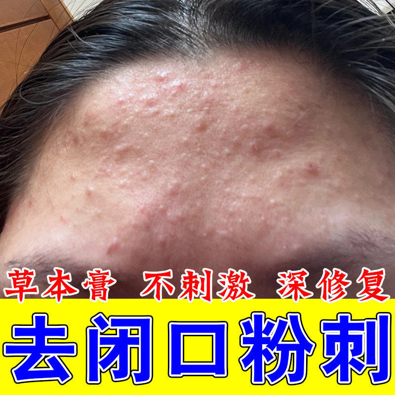 额头闭口粉刺脸红肿疙瘩额头痘粉刺内分泌失调修复草本温和舒缓膏