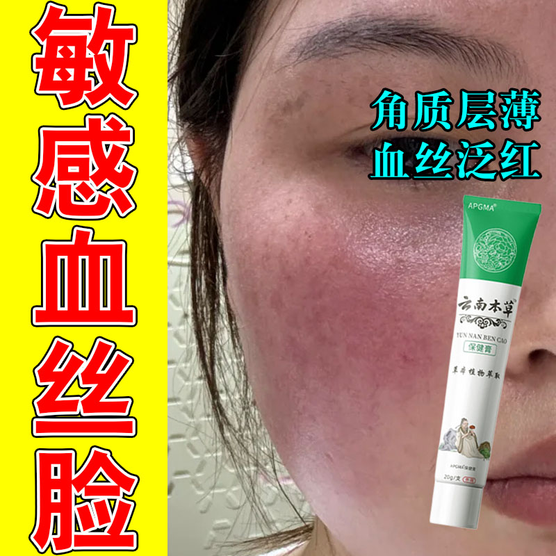 脸上红血丝激素脸角质层增厚敏感修复屏障受损脸部泛红保湿膏