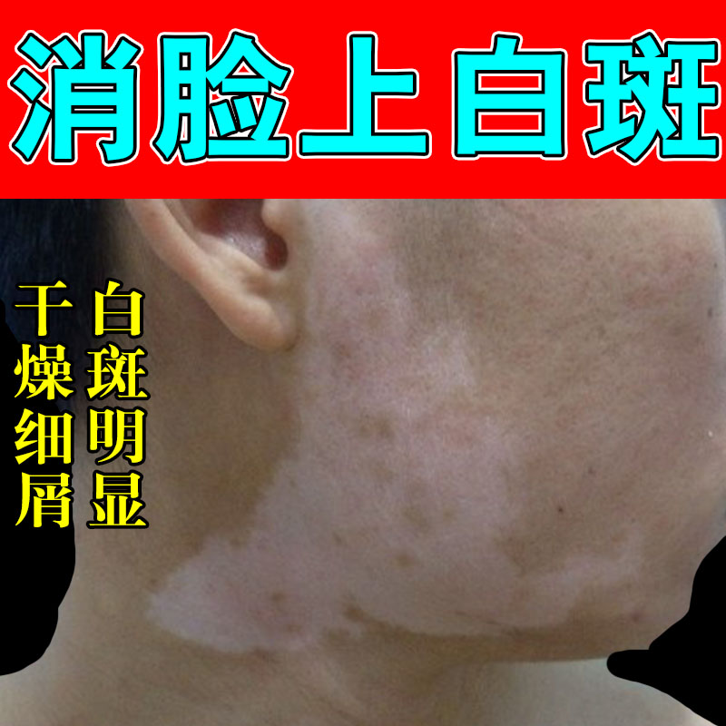 脸上有白斑汗斑净皮肤白斑去脸上白斑后背汗斑深斑点草本修护乳膏