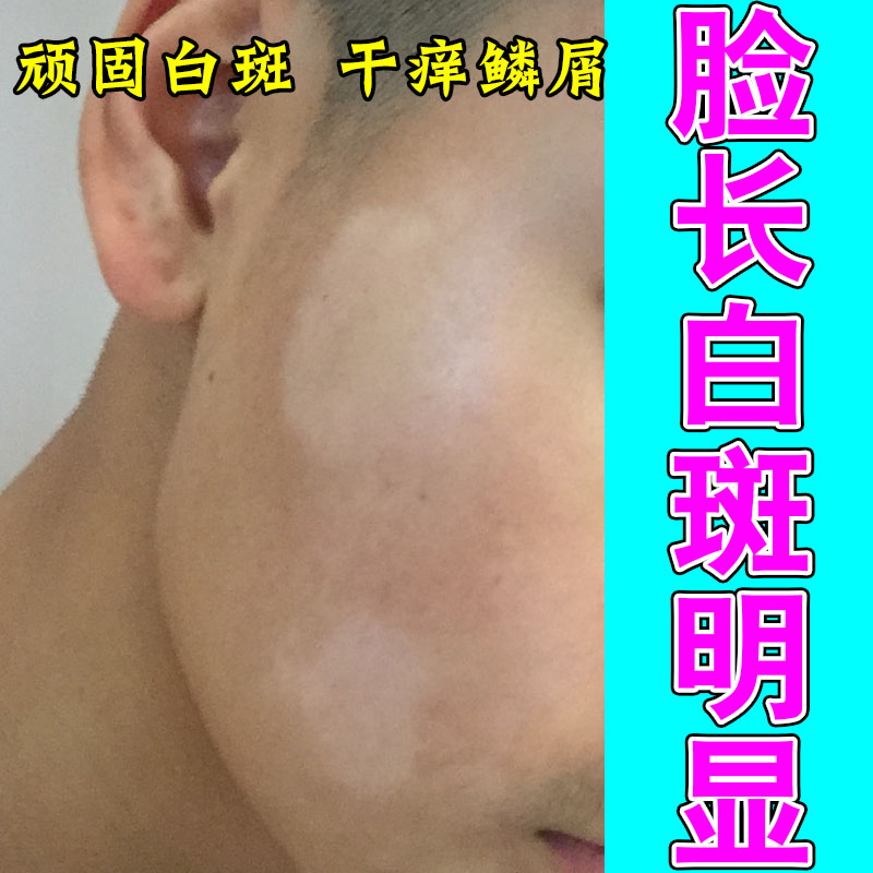 脸上长有白斑皮肤有白斑身上有白色斑块促进身体黑色素生长修护膏