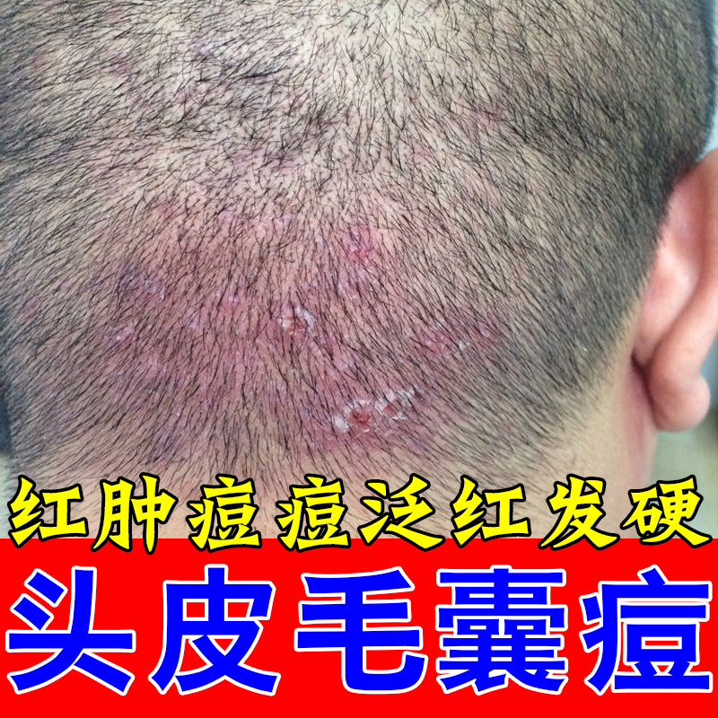 头皮毛囊头上长痘硬块疙瘩头部红肿起脓包毛囊发痒草本修护膏