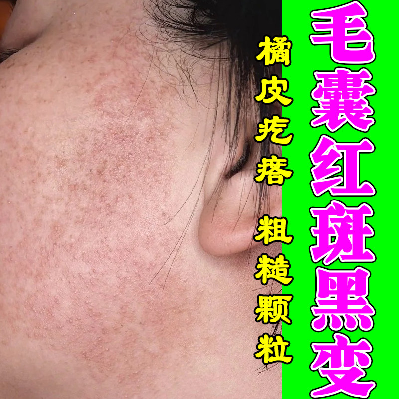 脸上毛囊红斑黑变毛周角化面颊颗粒凸角质堆积暗沉发黑泛红修护膏