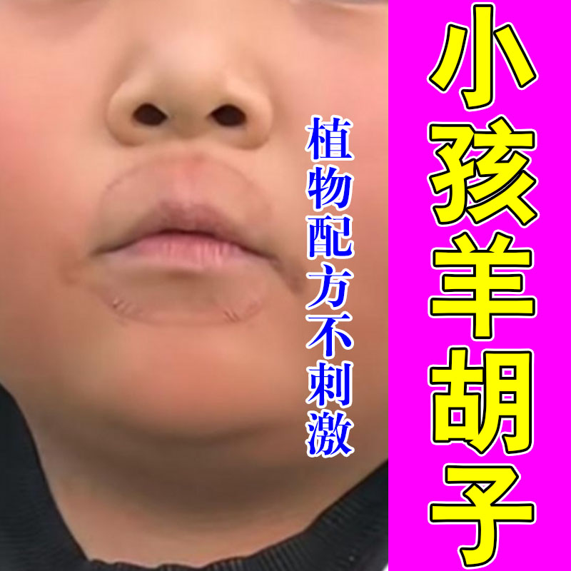 小孩口周泛红结痂干痛频繁舔嘴嘴角起皮肌肤不适草本润肤膏