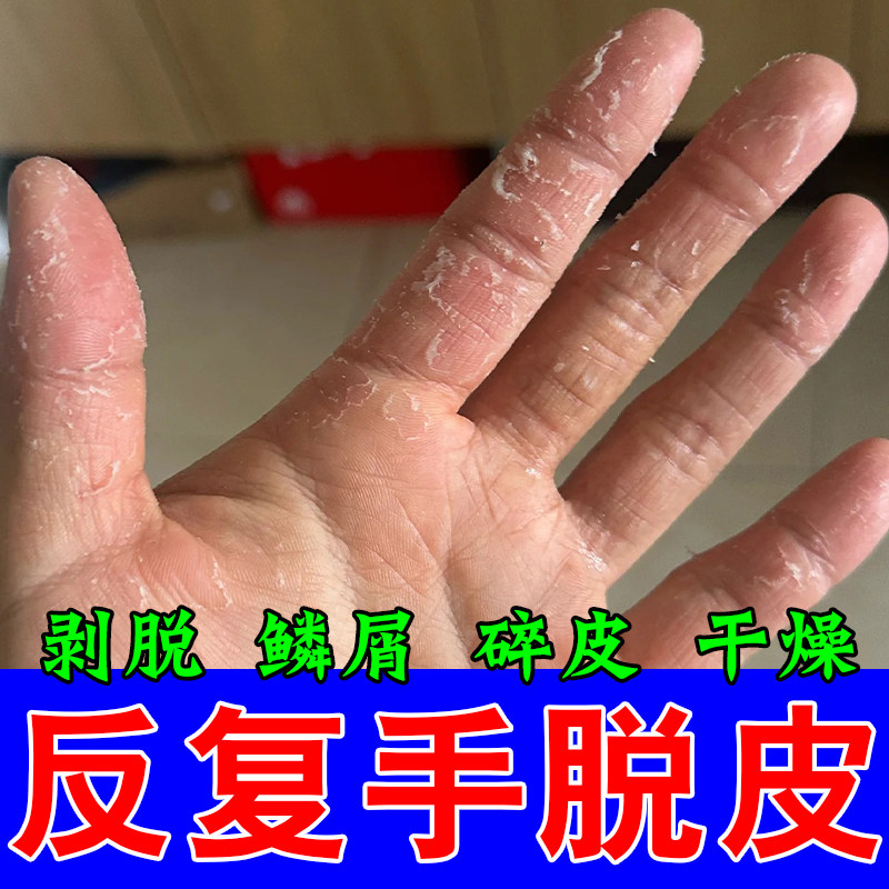 手脱皮严重脱皮剥脱性角质松懈手上起皮干燥手爆皮草本乳膏