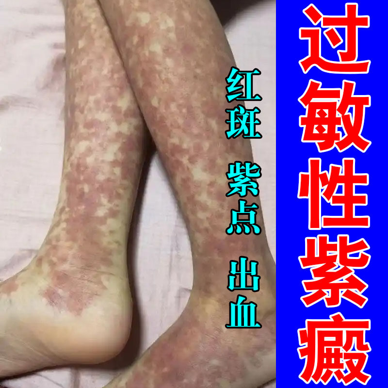 肌肤紫斑淤点舒缓淡化手上色素沉淀红点瘀斑血管红点软膏