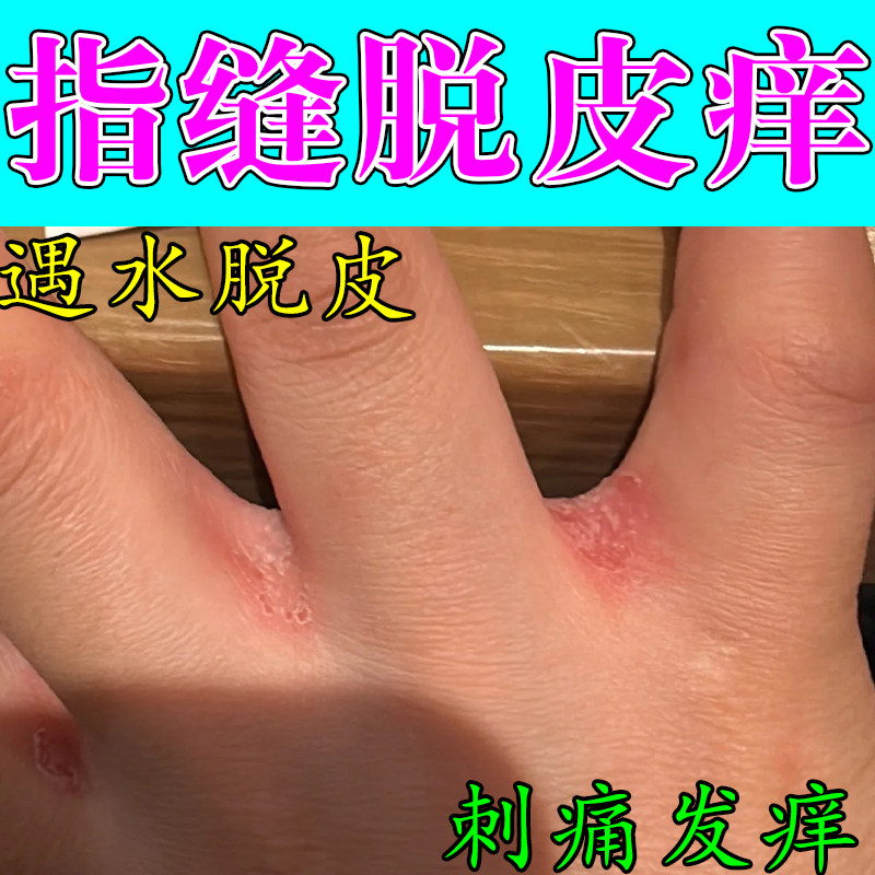 手指缝脱皮渗水发白经常碰水起皮手缝脱皮真菌水泡开裂发红修护膏