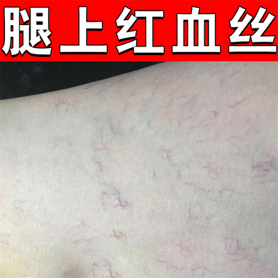 静脉曲张冷敷腿上红血丝青筋凸起蚯蚓腿老烂腿毛细血管扩张软膏