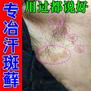 汗斑花斑专用腋下长汉斑片状褐斑红斑白斑皮肤去汗斑净软膏