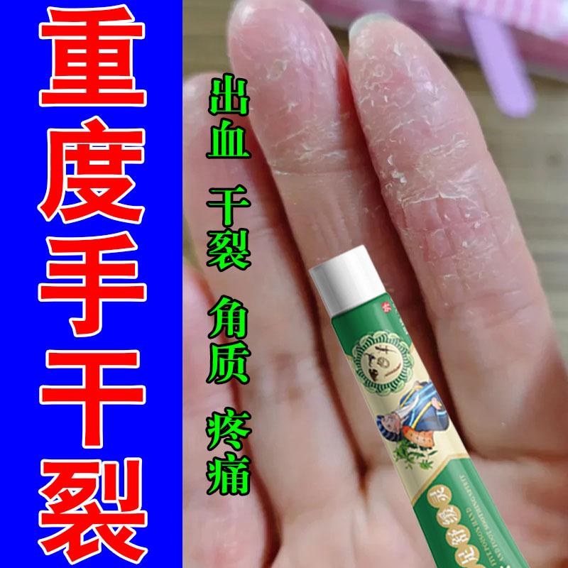 角化型湿手指脱皮干裂手足真菌痒角质增厚发开硬裂手痒修护膏