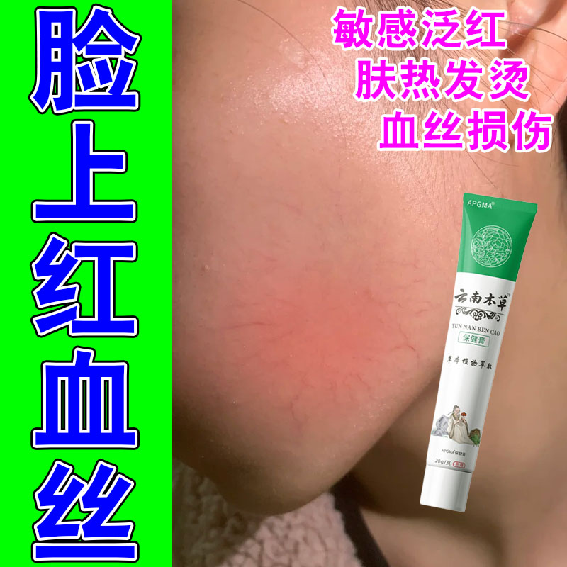 冶脸上的红血丝角质层薄修复红脸脸颊红血丝泛红发痒草本乳膏