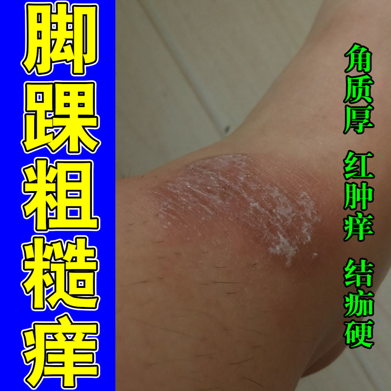 脚踝干燥起皮发痒脚脖子上红肿红斑粗糙痒红肿痒草本修护乳膏