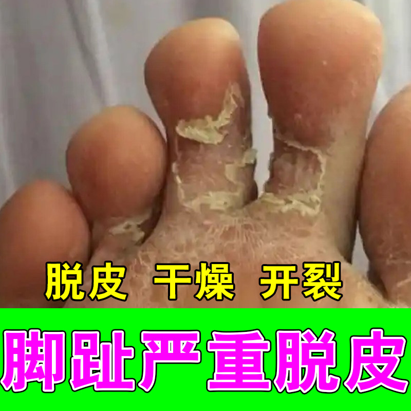 脚指缝起皮痒脚趾中间分离发白开裂疼脚真菌起皮舒缓修护软膏